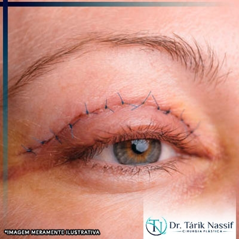 Cirurgia das Pálpebras Blefaroplastia - Dr. Tárik Nassif Cirurgia Plástica
